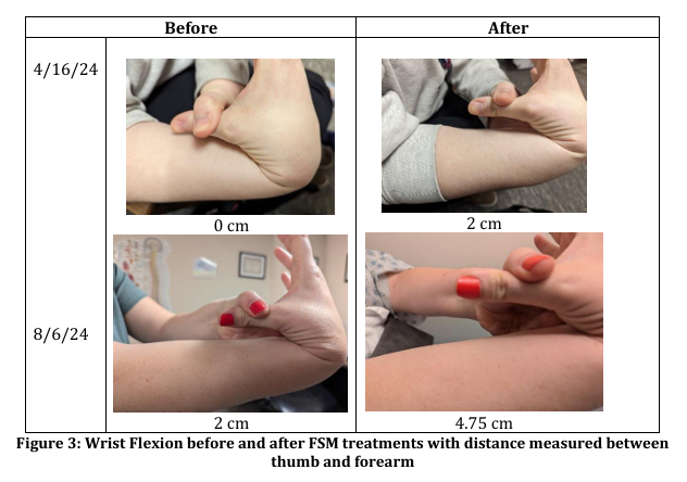 EDS before-after FSM treatment