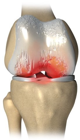osteoarthritis-knee
