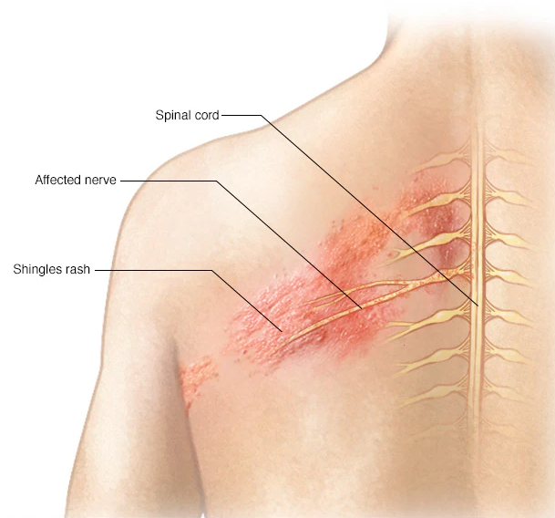 post herpetic neuralgia
